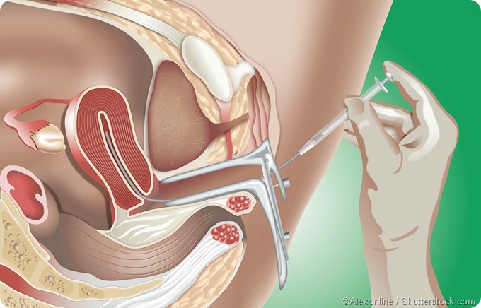 Intrauterine Insemination (IUI) illustration